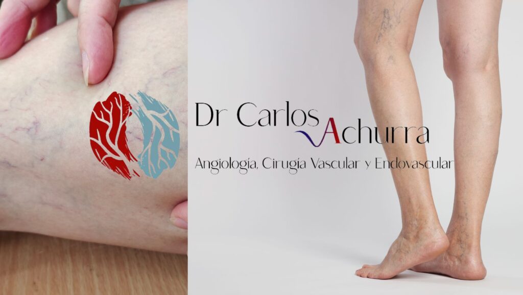 ANGIOLOGIA_DR CARLOS ACHURRIA Cancun varices